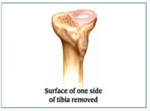 Tibia surface removed