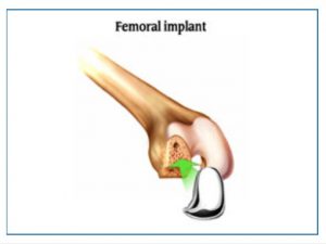femoral Implant