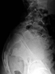 lumbrosacral-spine-x-ray