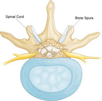 spinal-stenosis diagram