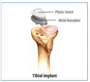 tibial implant