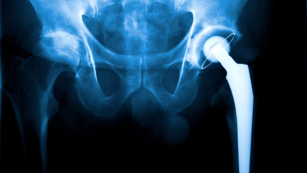 Oxinium Hip Replacement Cost thumbnail