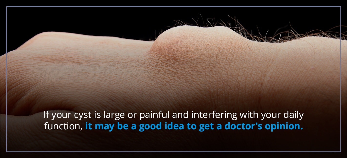 If your cyst is large or painful and interfering with your daily function