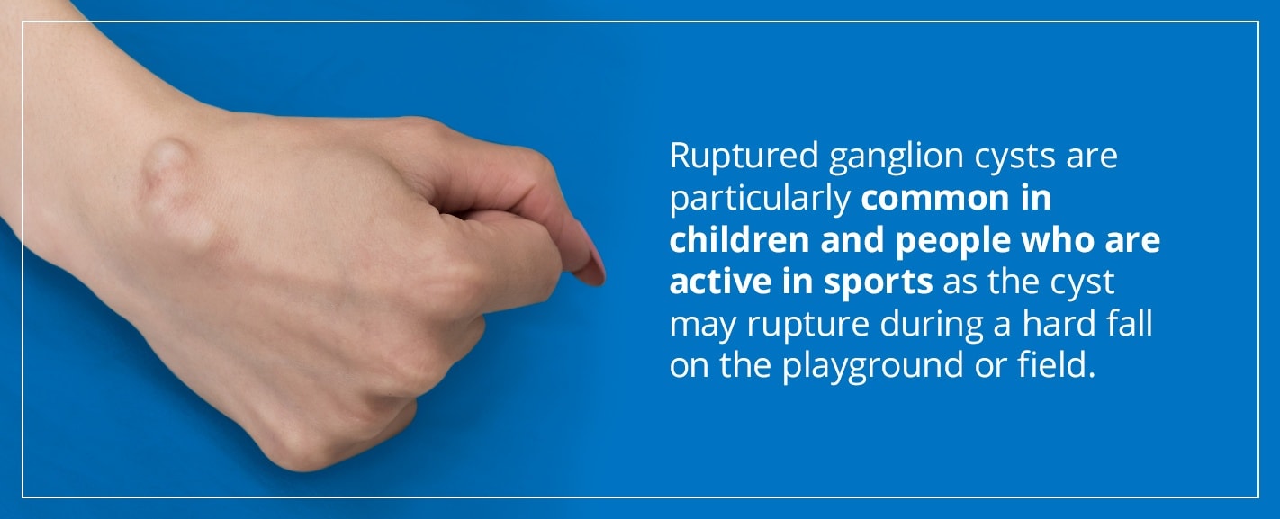 ruptured ganglion cysts are particularly common in children and people who are active in sports