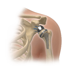 Shoulder Arthritis and Shoulder Replacement