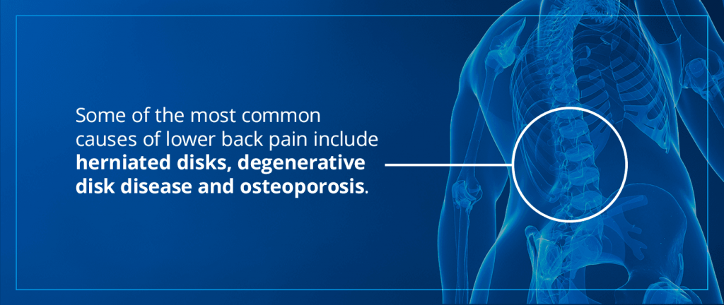Causes of Low Back Pain