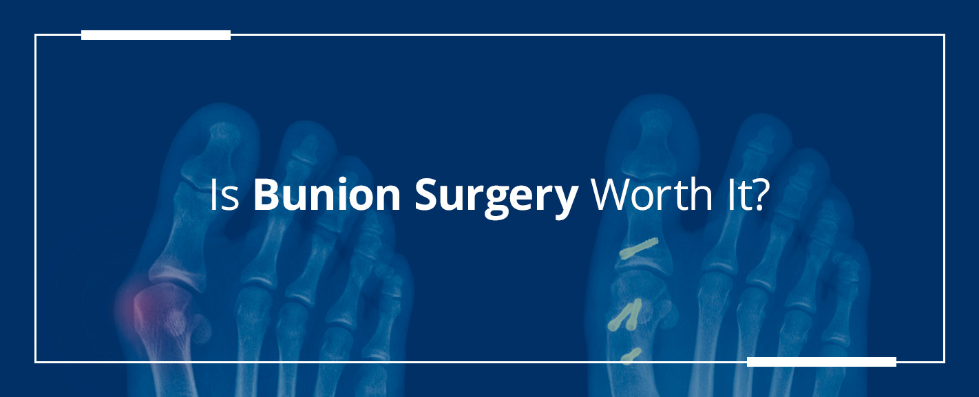 Is Bunion Surgery Worth It?