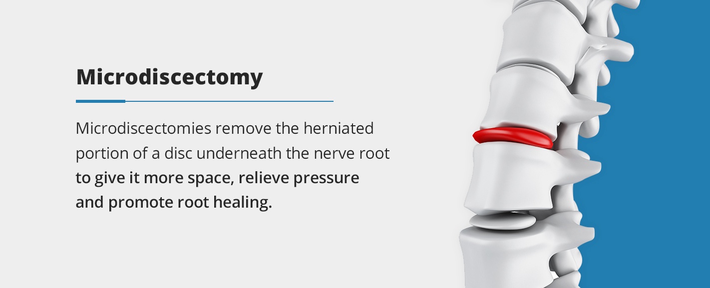 microdiscectomies remove the herniated portion of a disc underneath the nerve root to give it more space, relieve pressure and promote root healing