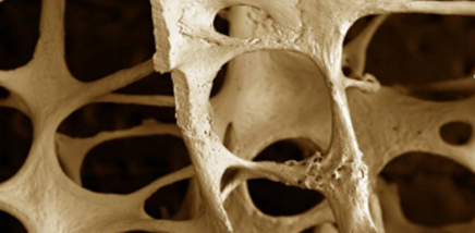 osteoporosis-bones