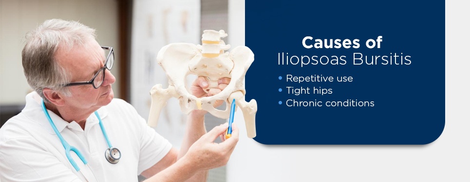 Causes of Iliopsoas Bursitis iliopsoas bursitis causes