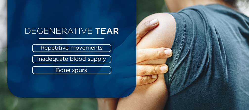 Degenerative Tear degenerative tear of the shoudler