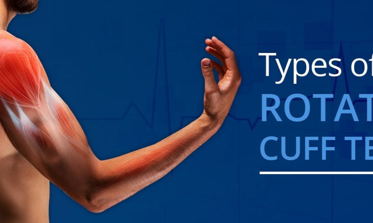 Types of Rotator Cuff Tears OrthoBethesda