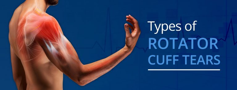 Types of Rotator Cuff Tears | OrthoBethesda