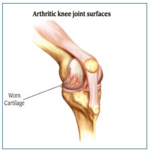 Arthrtic Knee
