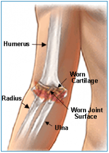 arthritic elbow joint diagram