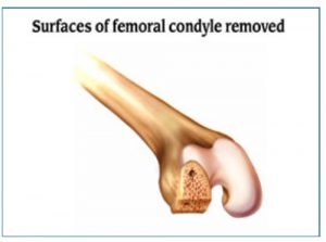 Femoral Surface removed