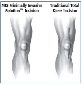 MIS Incision