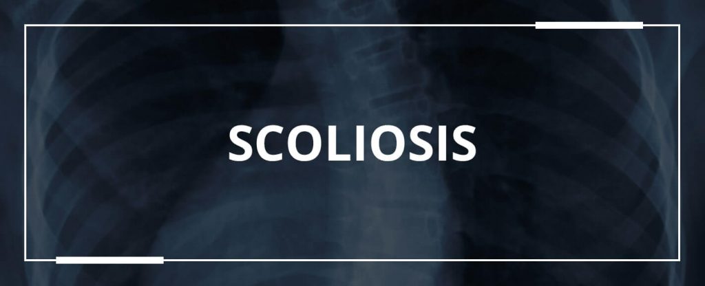 Scoliosis - Everything To Know | OrthoBethesda