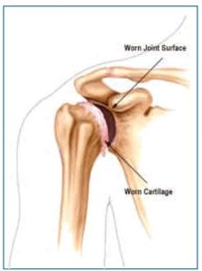 arthritic shoulder
