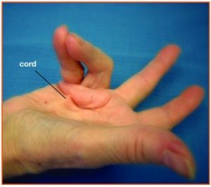 Dupuytrens disease palm and fingers