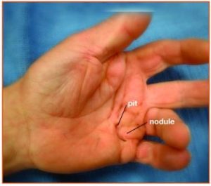 Dupuytrens disease palm of hand