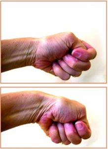 Finkelstein maneuver