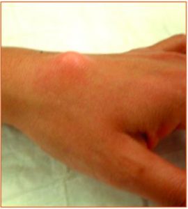 Ganglion cyst top side (dorsum) wrist
