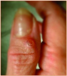 Ganglion end joint of finger (mucous cyst)