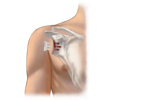 glenoid-implant