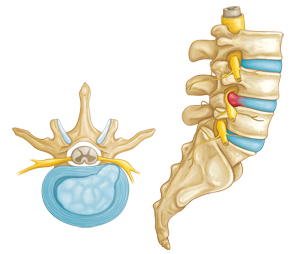 Herniated disc side view and cross-section
