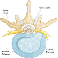 slipped or herniated disk 