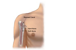 humeral-head