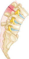 lumbar-ligament-tear