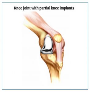 partial knee implants