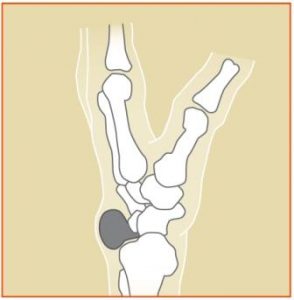 Cross-section of wrist showing stalk (or root) of ganglion