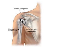 shoulder-implants