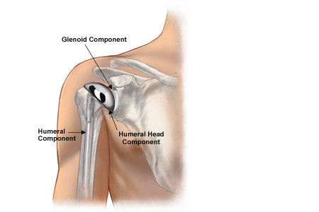 Shoulder Button Surgery Information For Your Shoulder Surgery | OrthoBethesda