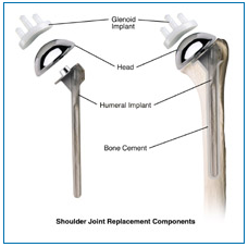shoulder joint replacement components