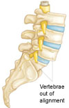 spondylolisthesis