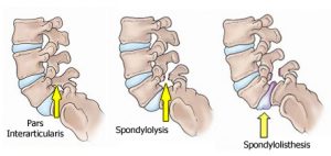 spondylolysis-spondylolisthesis-diagram