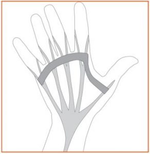 Dupuytrens disease treatment diagram