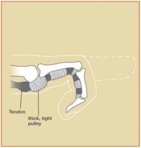 trigger finger diagram