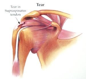 The Supraspinatus