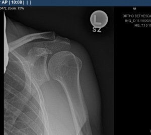 Rotator Cuff Disorders: The Facts