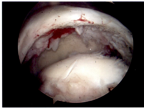 Rotator Cuff Disorders: The Facts