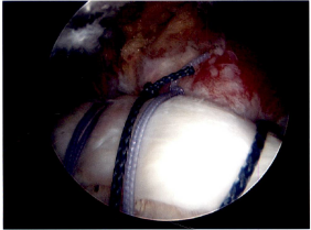 Rotator Cuff Disorders: The Facts