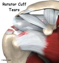 Rotator Cuff Disorders: The Facts