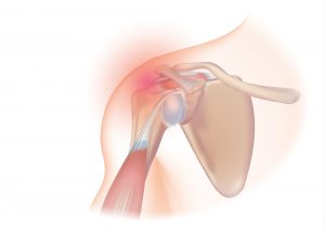 Rotator Cuff Disorders: The Facts