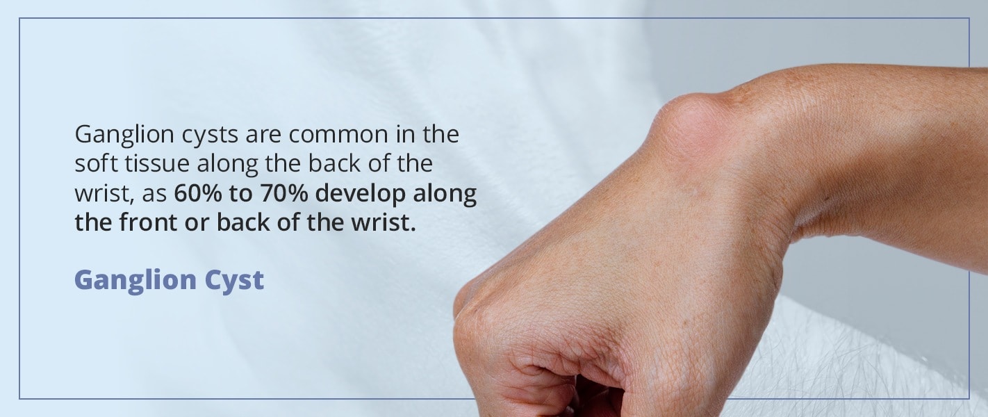 ganglion cysts are common in the soft tissue along the back of the wrist