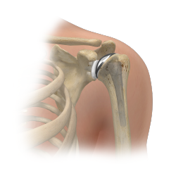 Shoulder Arthritis and Shoulder Replacement